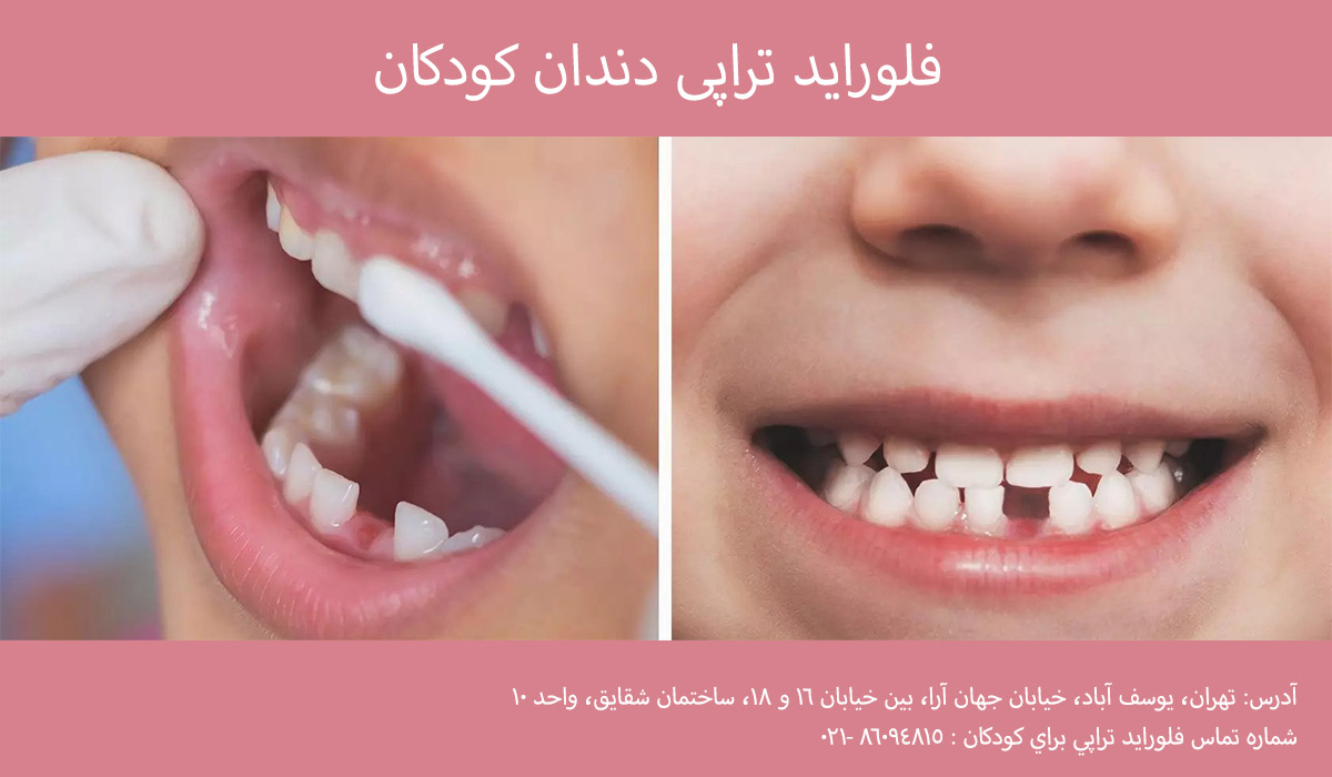 فلوراید تراپی کودکان