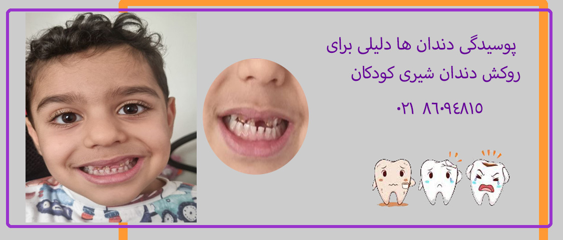 روکش دندان بچه ها