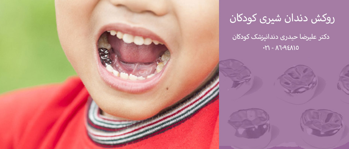 روکش دندان شیری کودکان