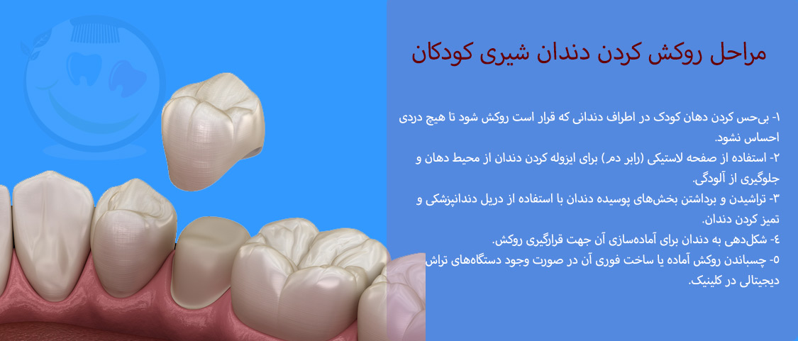 روکش دندان بچه ها