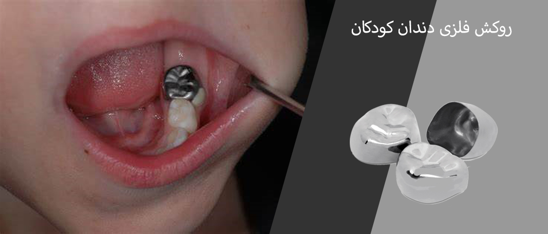 روکش فلزی دندان کودکان