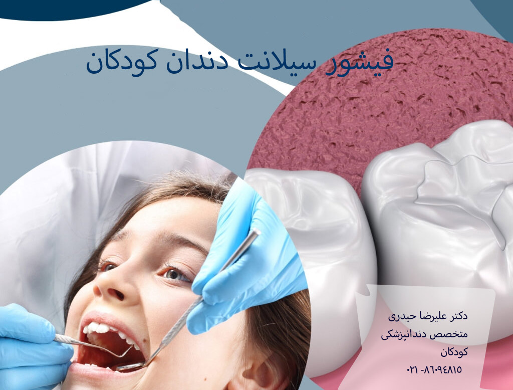 فیشور سیلانت دندان کودکان