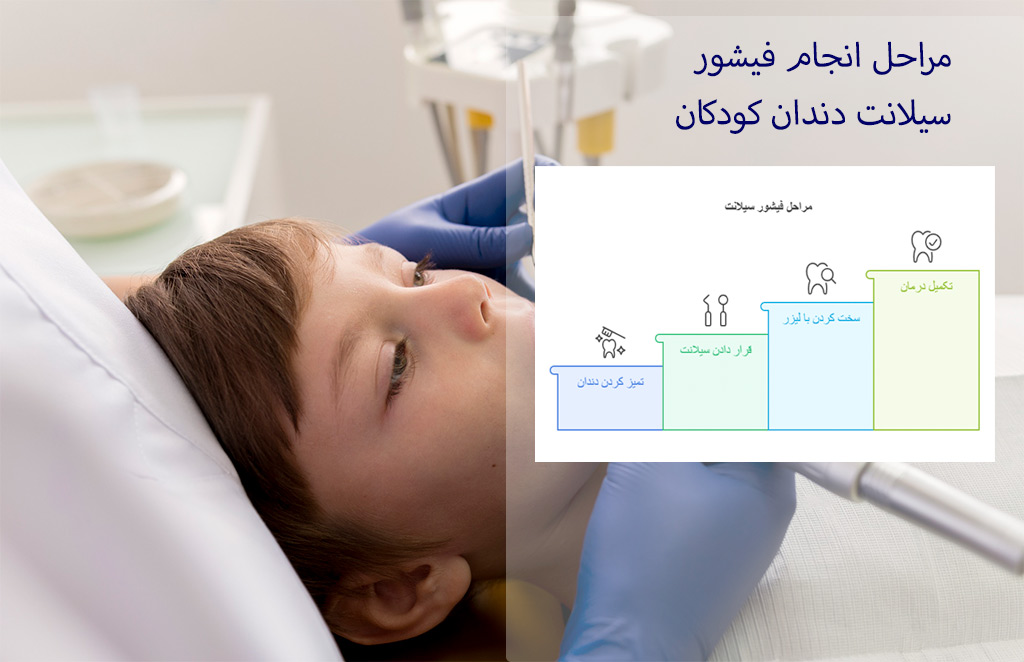 مراحل انجام فیشور سیلانت دندان کودکان
