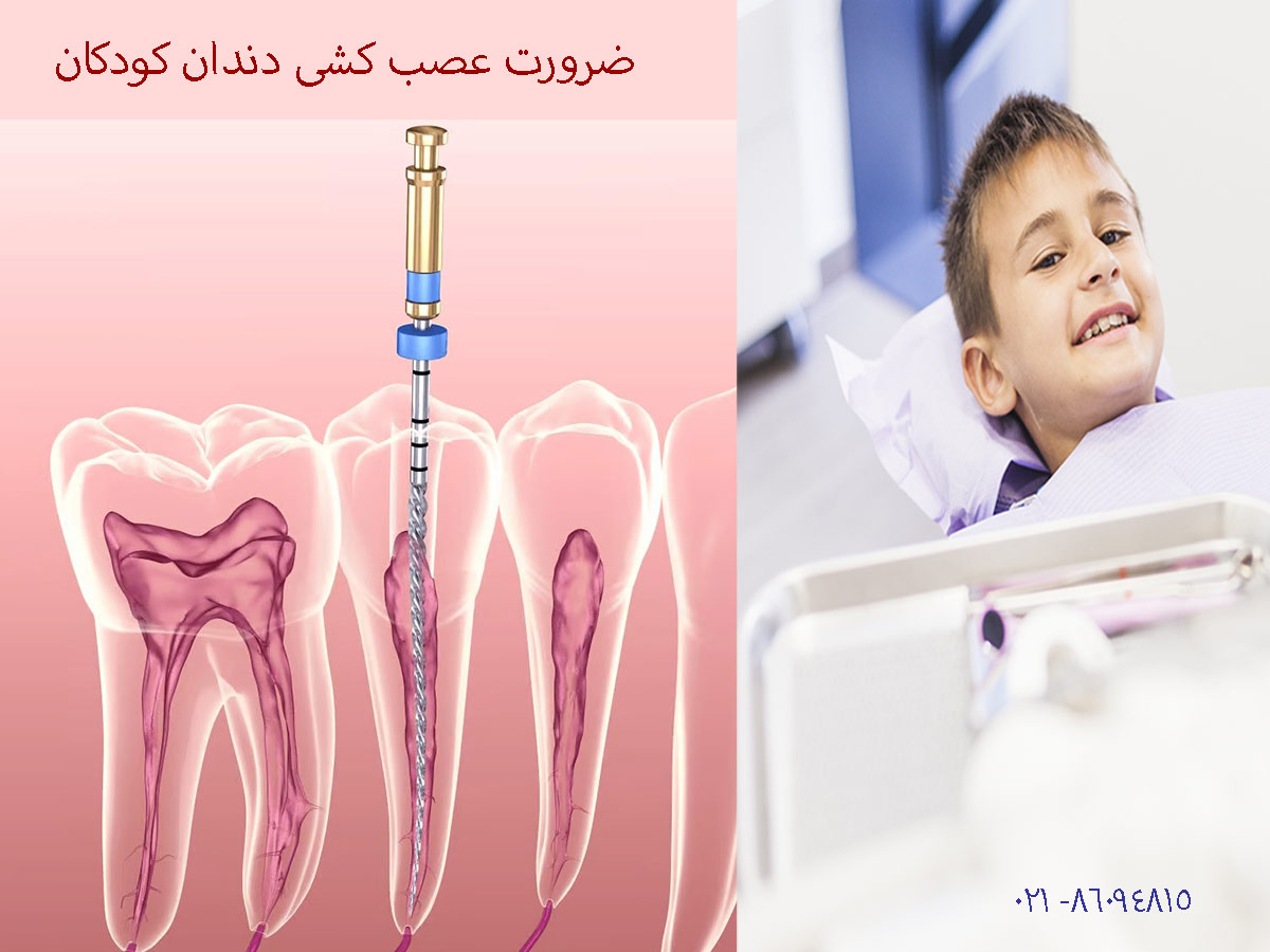 ضرورت عصب کشی دندان شیری کودکان